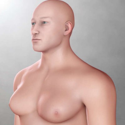 ژنیکوماستی چیست و چقدر خطرناک است؟