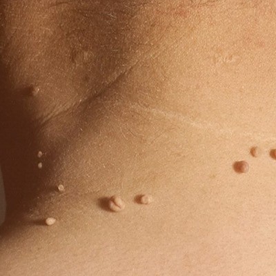 بهترین راهکارها برای‌ درمان گوشت‌های اضافی