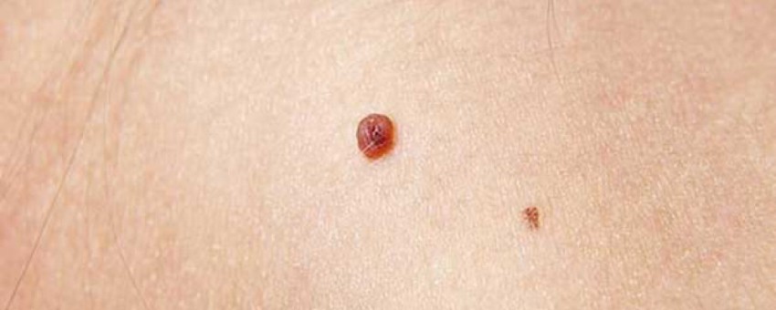 بهترین راهکارها برای درمان گوشتهای اضافی